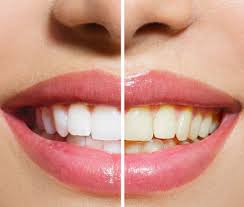 Teeth Whitening Gel